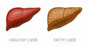 Fatty-liver-grade-1-2-3-ka-matlb-lakshan-karan (1)